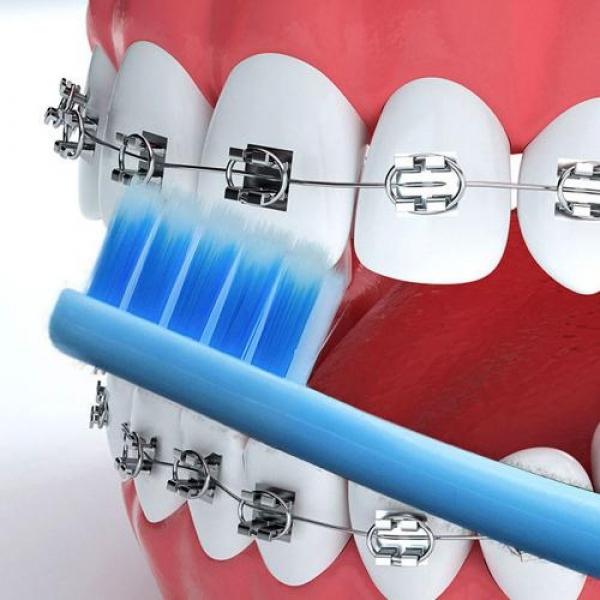 V컷 교정칫솔 개별포장 U컷 틈새 교정기 어금니 교정용 치솔