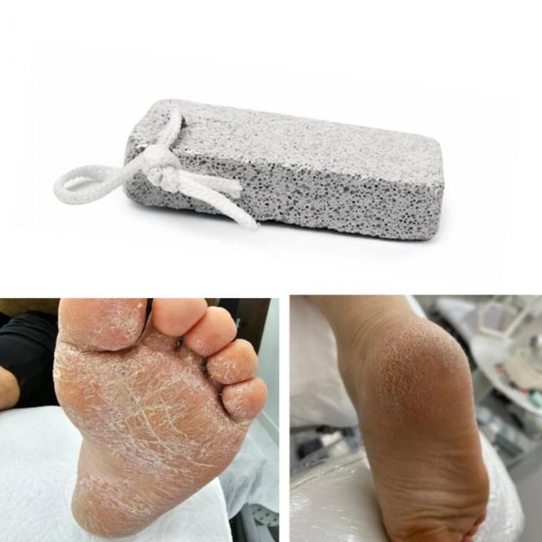 풋케어 각질밀이 무릎 팔꿈치 발바닥 발뒤꿈치 돌 각질제거