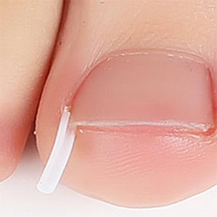 발톱보호기 10p 발톱정리 발톱케어 발톱들림